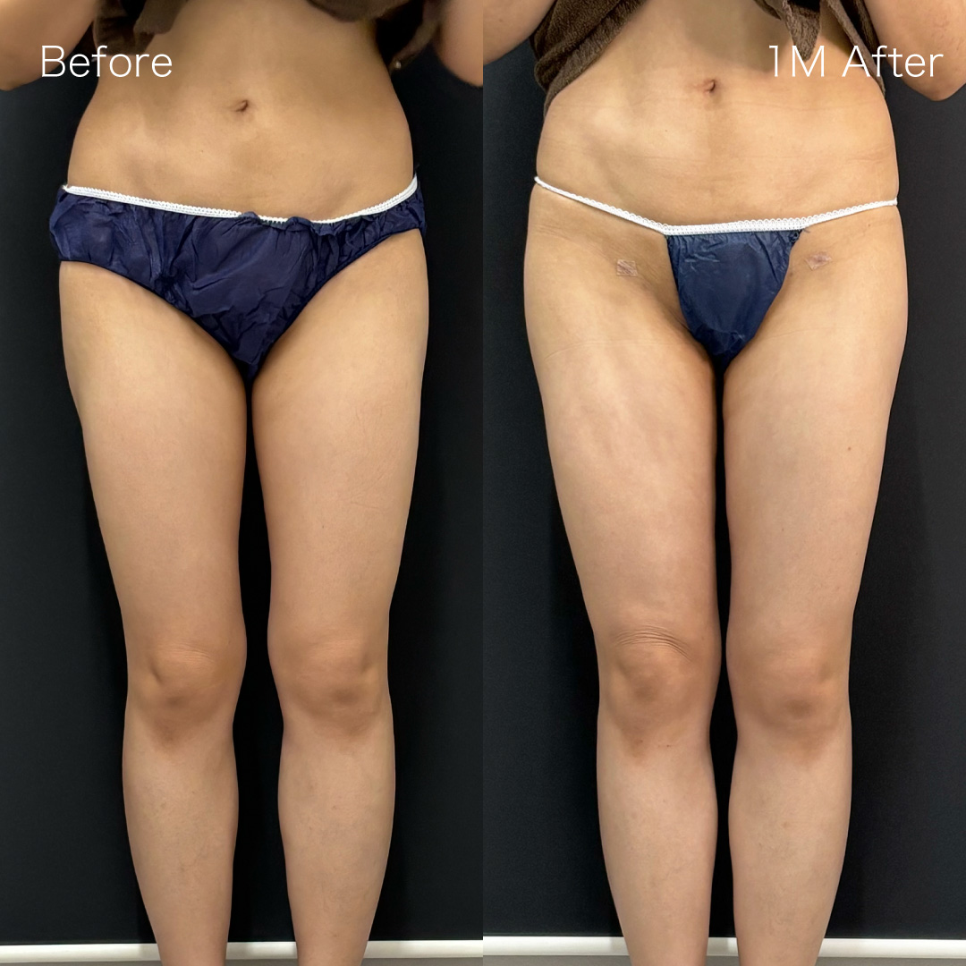 身体脂肪吸引の症例の症例画像