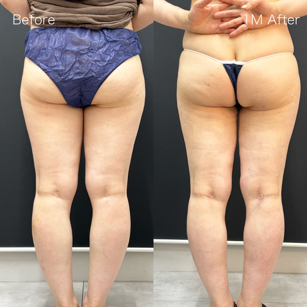 身体脂肪吸引の症例の症例画像