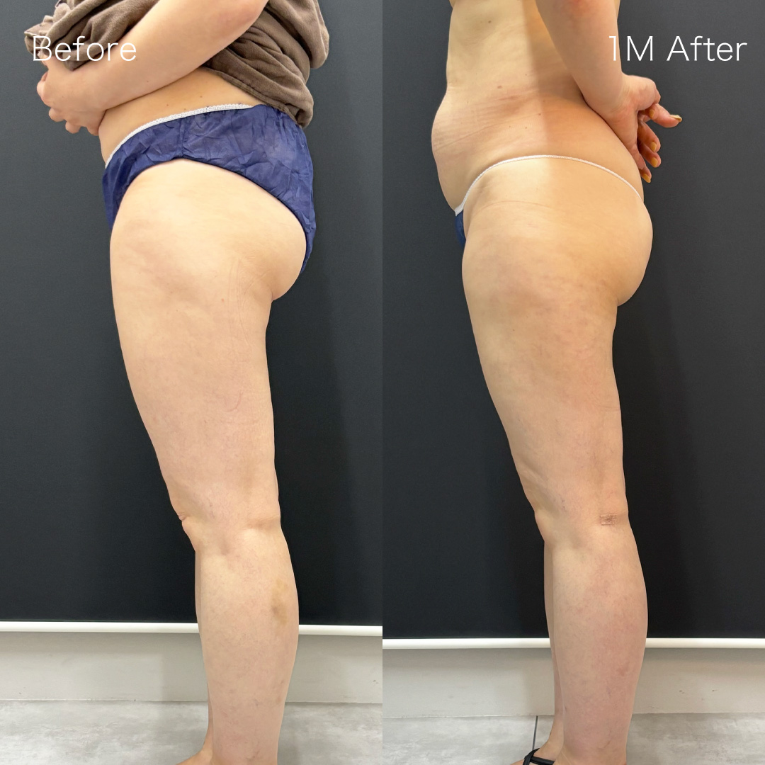 身体脂肪吸引の症例の症例画像