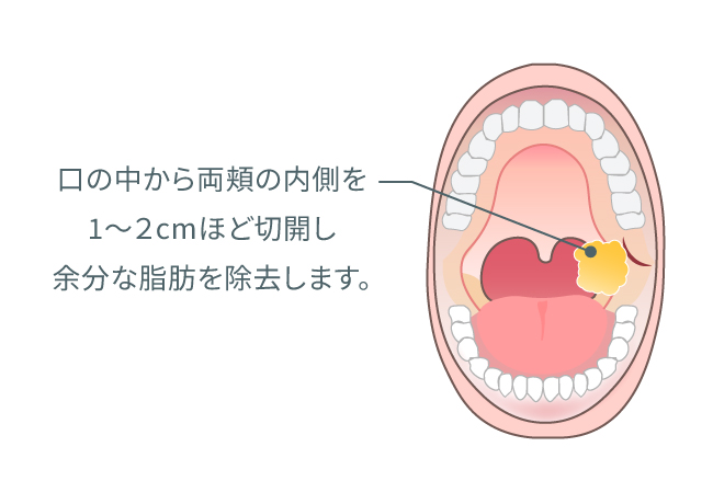 バッカルファット除去 イラスト