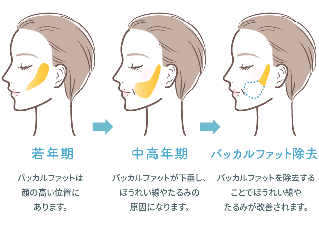 バッカルファット除去 イラスト