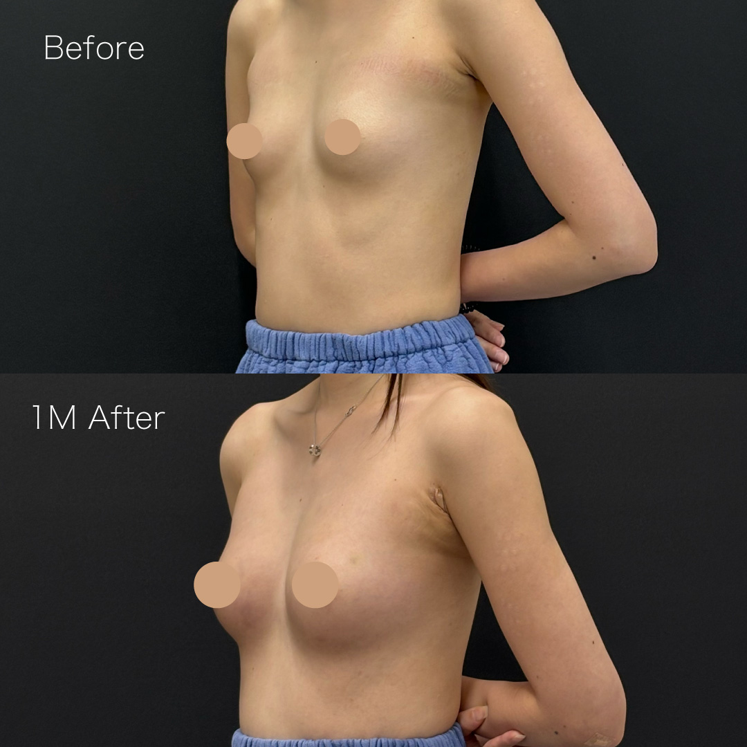 脂肪注入豊胸の症例の症例画像