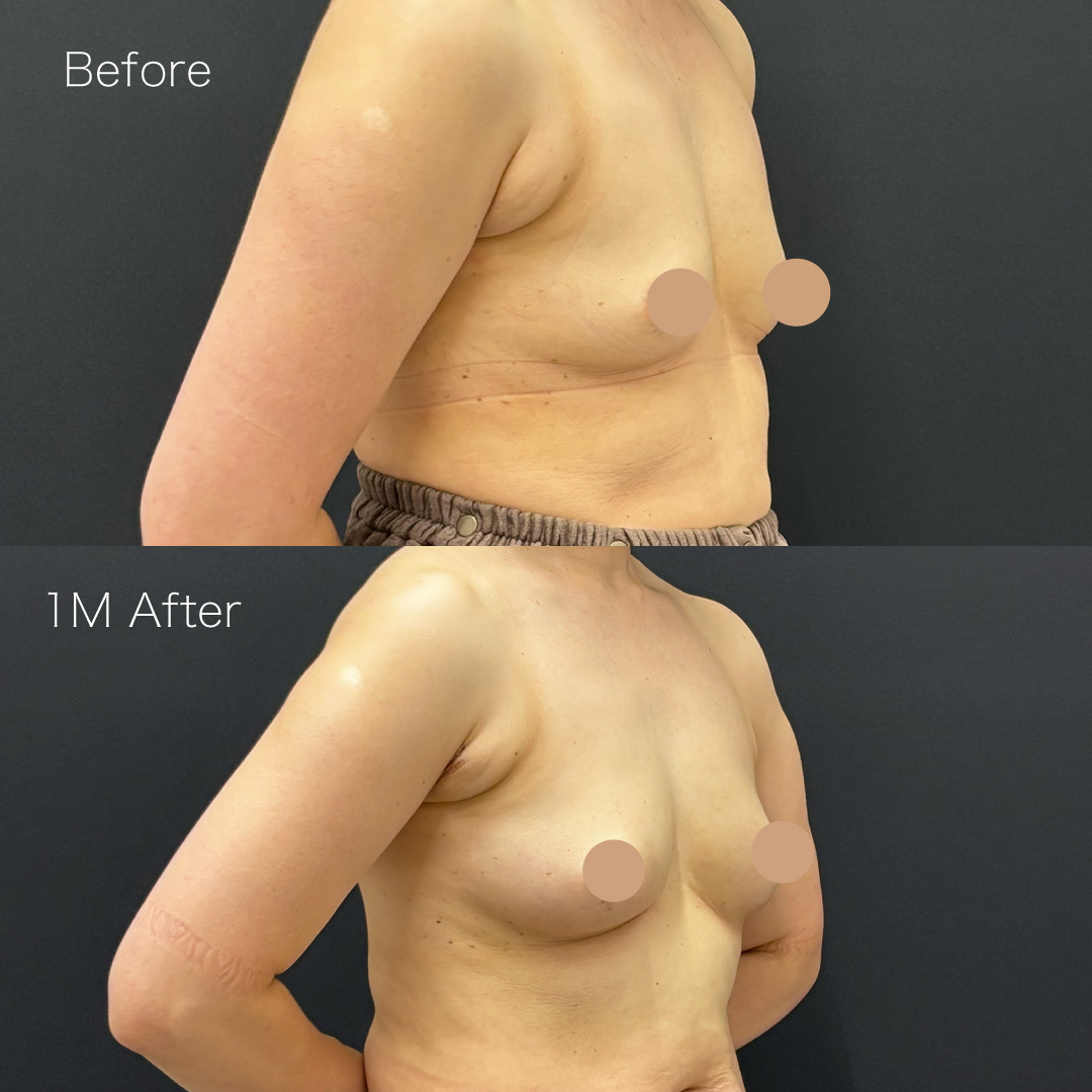脂肪注入豊胸の症例の症例画像