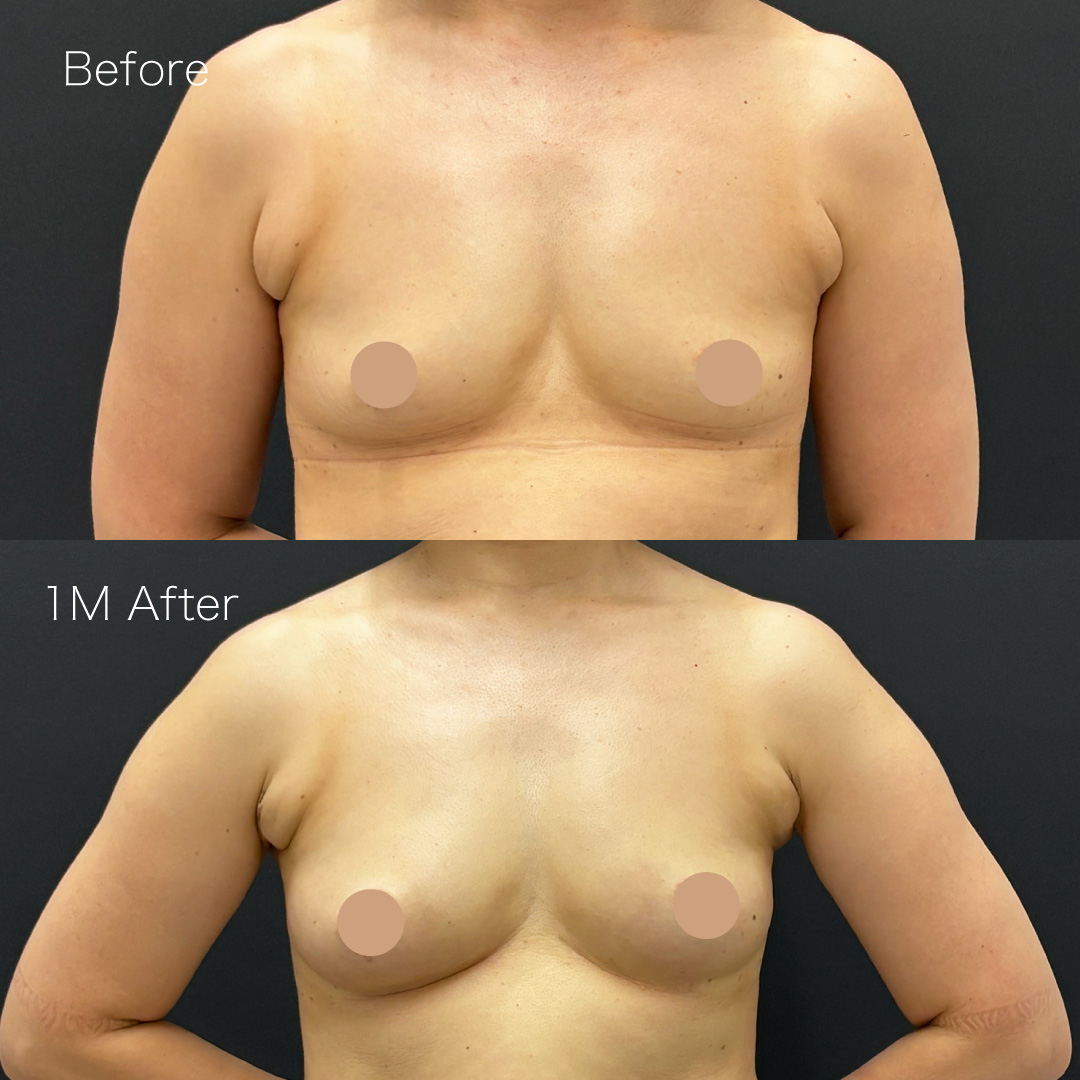 脂肪注入豊胸の症例の症例画像