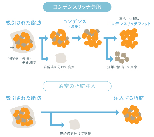 ミセルクリニック大阪梅田院の高品質な脂肪を作成