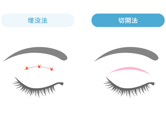 二重切開法 イラスト
