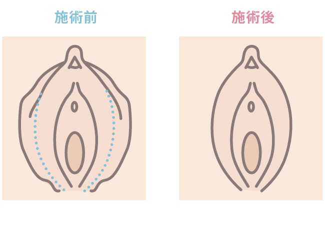 小陰唇縮小とは イラスト