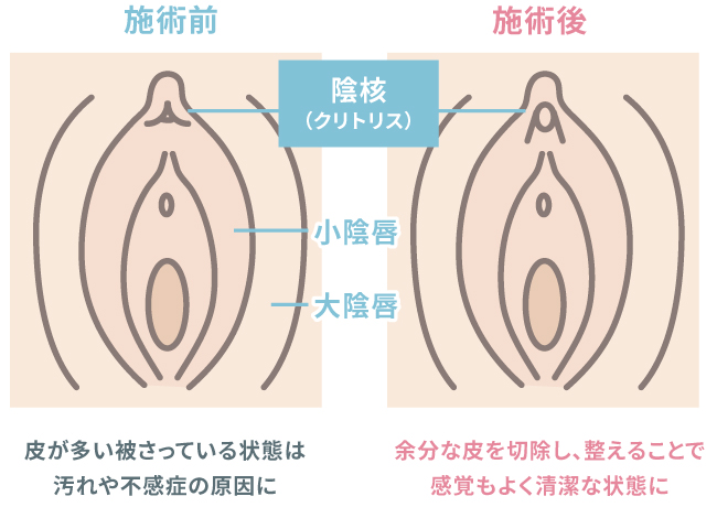 陰核（クリトリス）包茎術とは イラスト