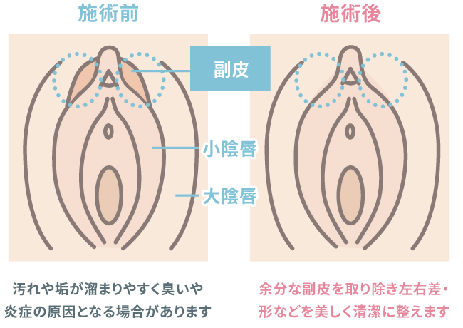 副皮除去とは イラスト