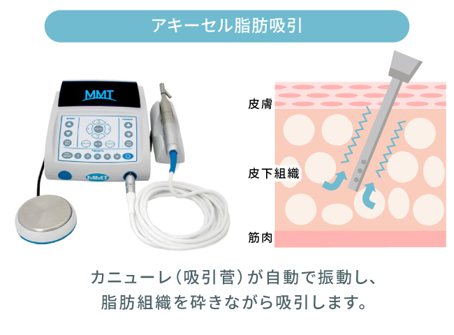 ミセルクリニック大阪梅田院の脂肪吸引で使用するアキーセル脂肪吸引