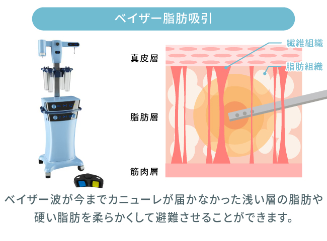 ミセルクリニック大阪梅田院の脂肪吸引で使用するベイザー脂肪吸引