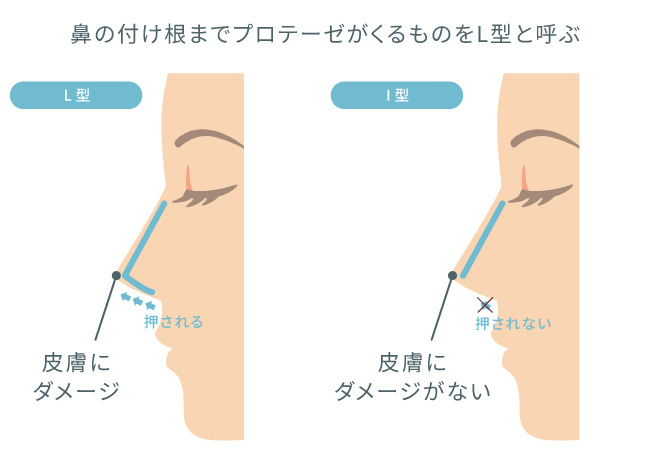 使用するプロテーゼについて イラスト