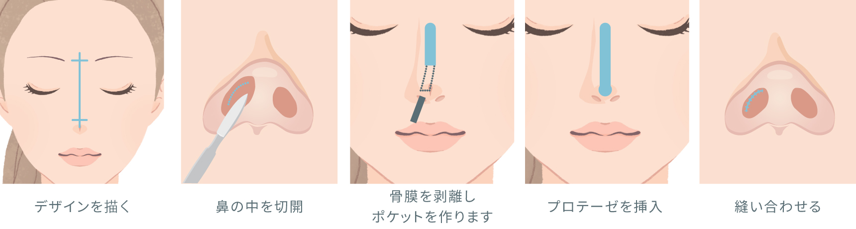 隆鼻術の流れ イラスト