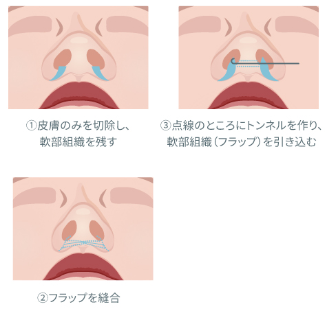 熱破壊式脱毛と蓄熱式脱毛の違いの図解