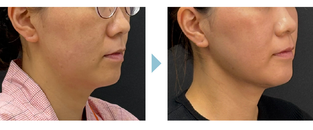 小顔脂肪吸引症例1